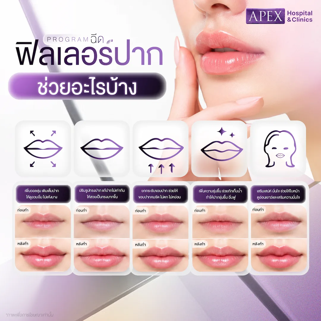 ฉีดฟิลเลอร์ปาก ช่วยอะไร