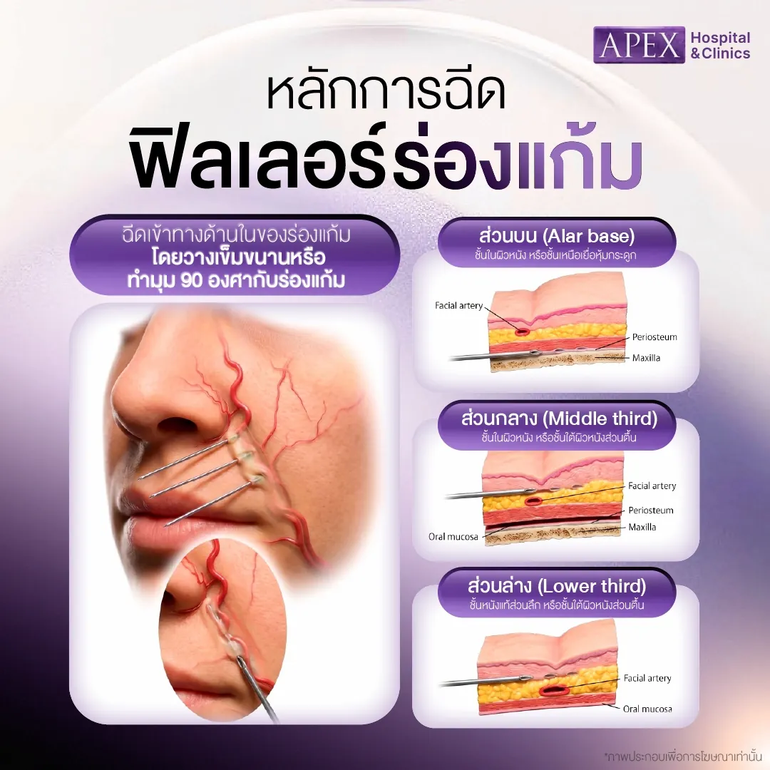 ฉีดฟิลเลอร์ร่องแก้มตรงไหนบ้าง