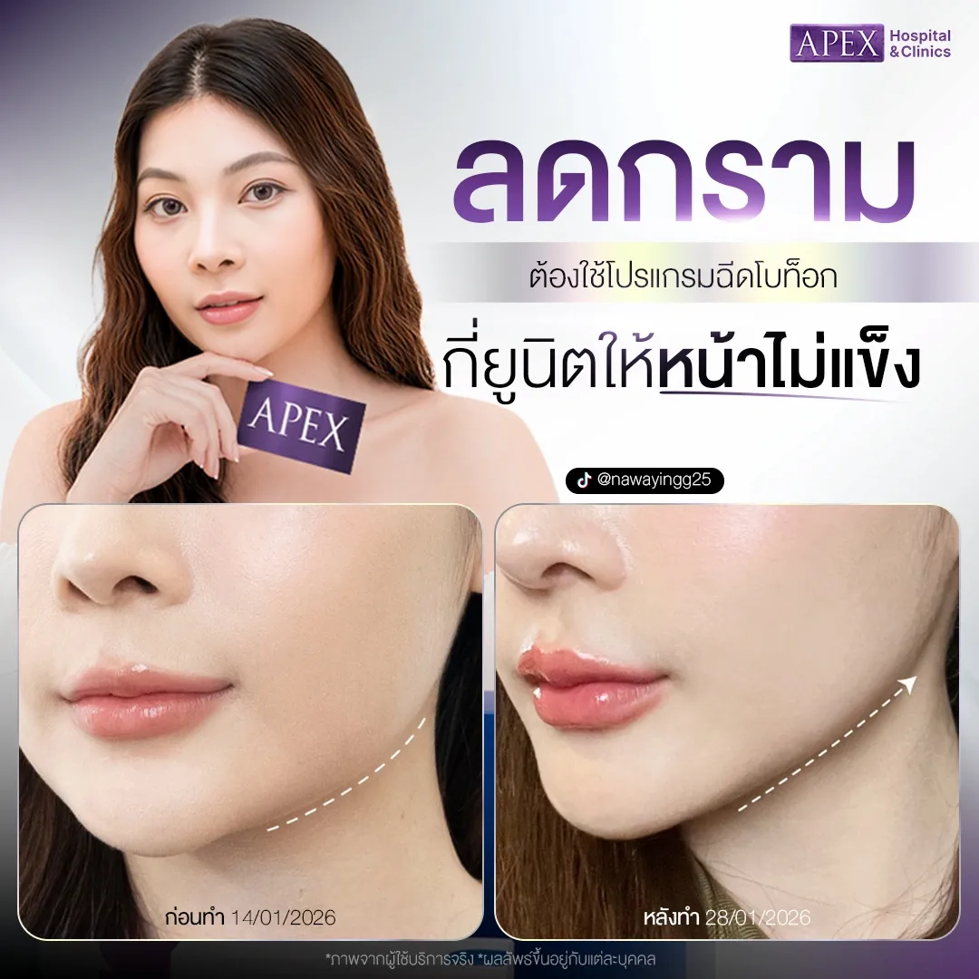 ฉีดโบท็อกกราม