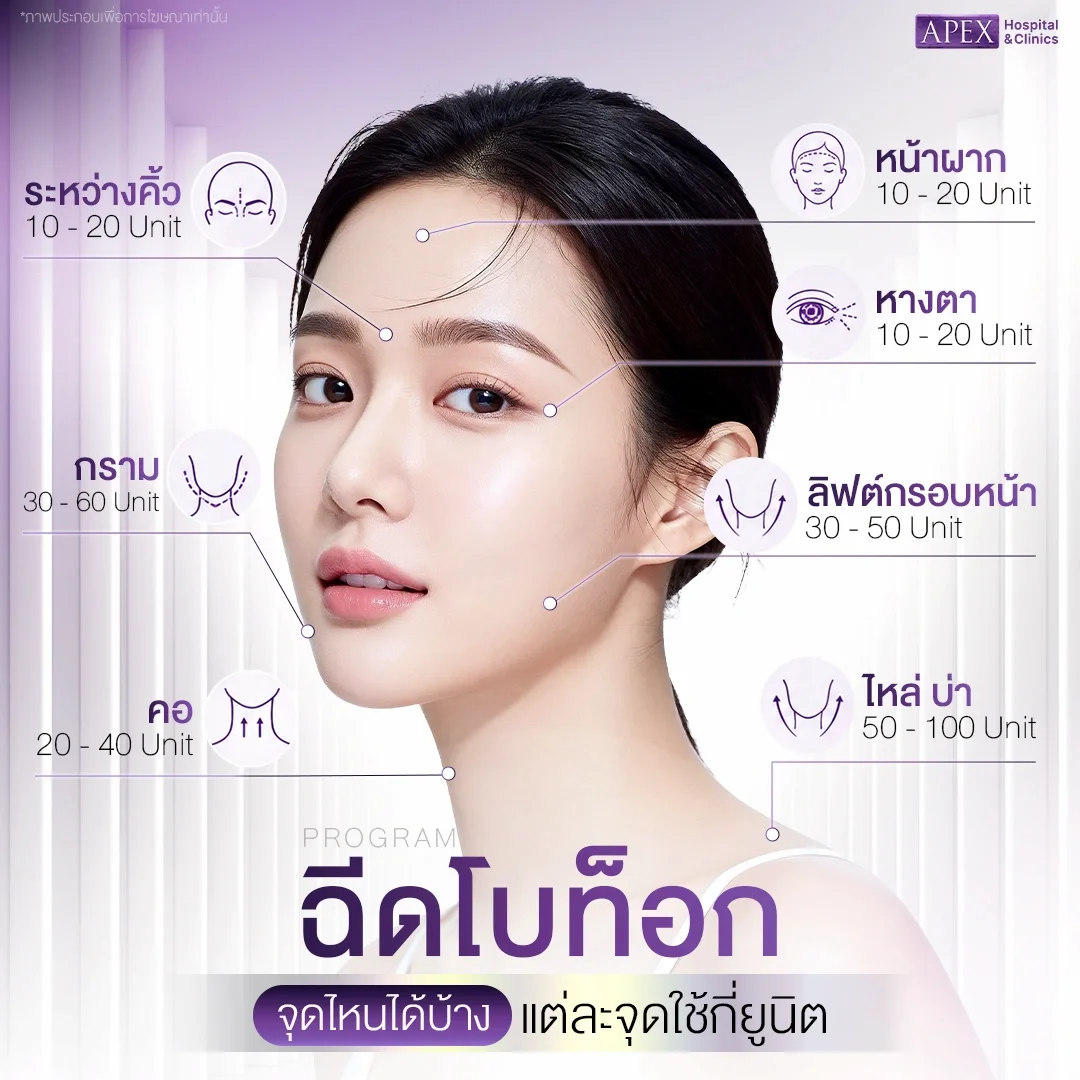 ฉีดโบท็อกจุดไหนได้บ้าง