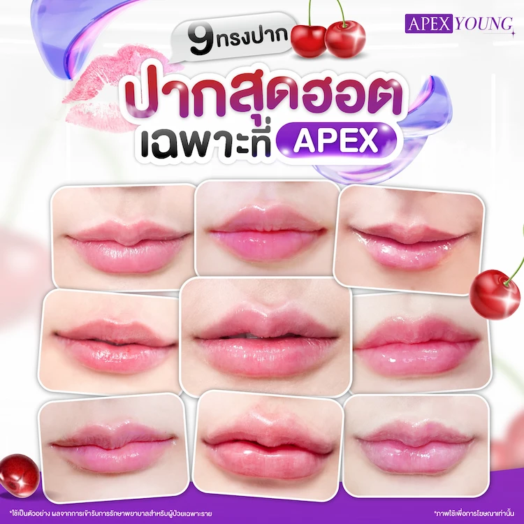 ทรงฉีดฟิลเลอร์ปาก