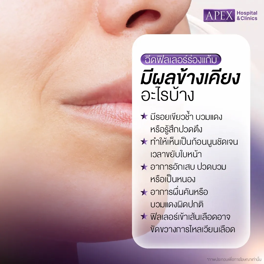 ผลข้างเคียงหลังฉีดฟิลเลอร์ร่องแก้ม