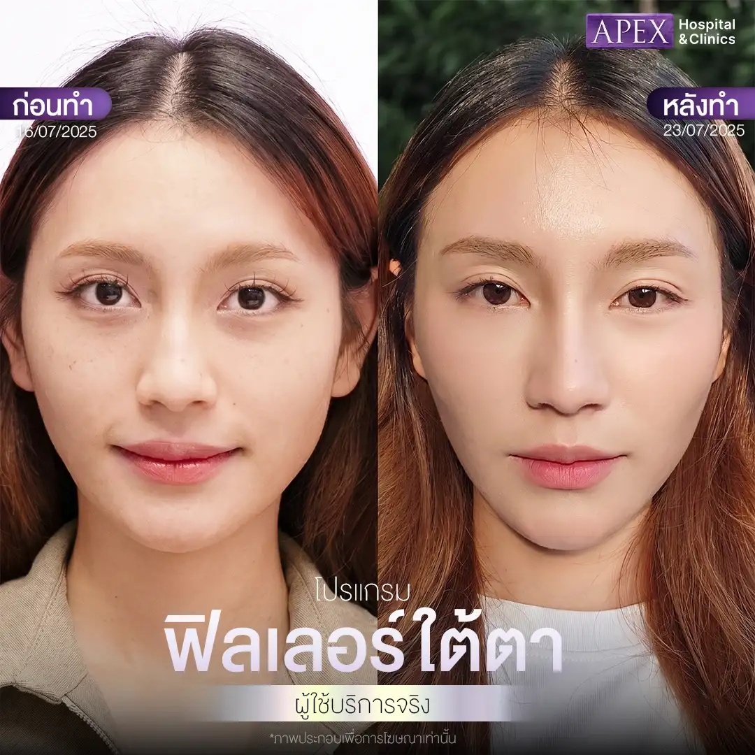 ผลลัพธ์หลังฉีดฟิลเลอร์ใต้ตา