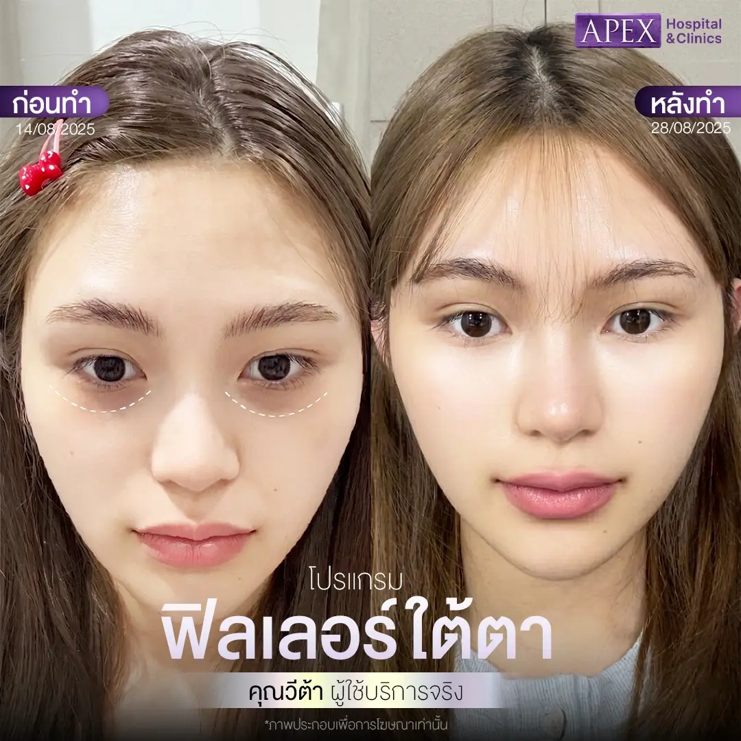 ผลลัพธ์หลังฉีดฟิลเลอร์ใต้ตา
