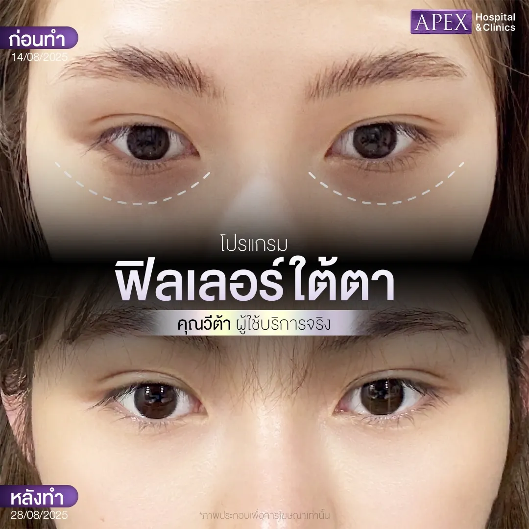 ผลลัพธ์หลังฉีดฟิลเลอร์ใต้ตา