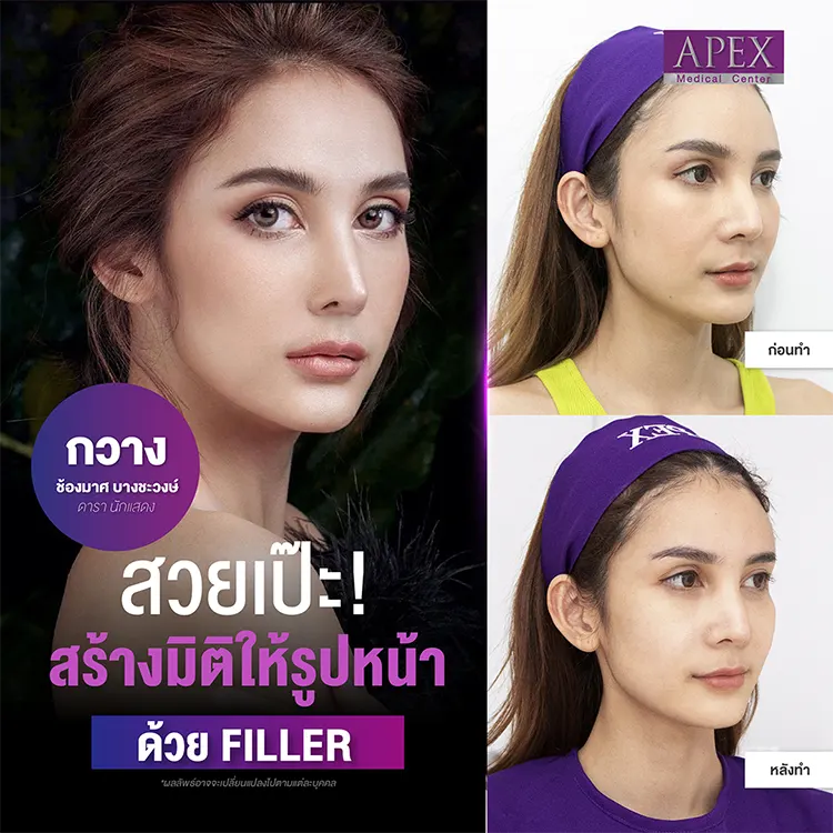 ฟิลเลอร์กรอบหน้า รีวิว
