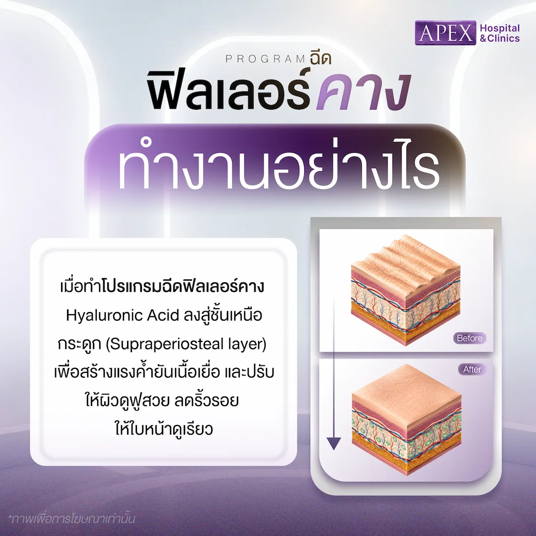 ฟิลเลอร์คาง มีกระบวนการทำงานอย่างไร