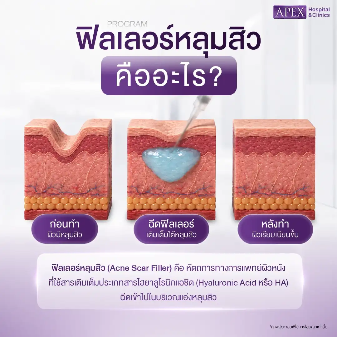 ฟิลเลอร์หลุมสิว คืออะไร