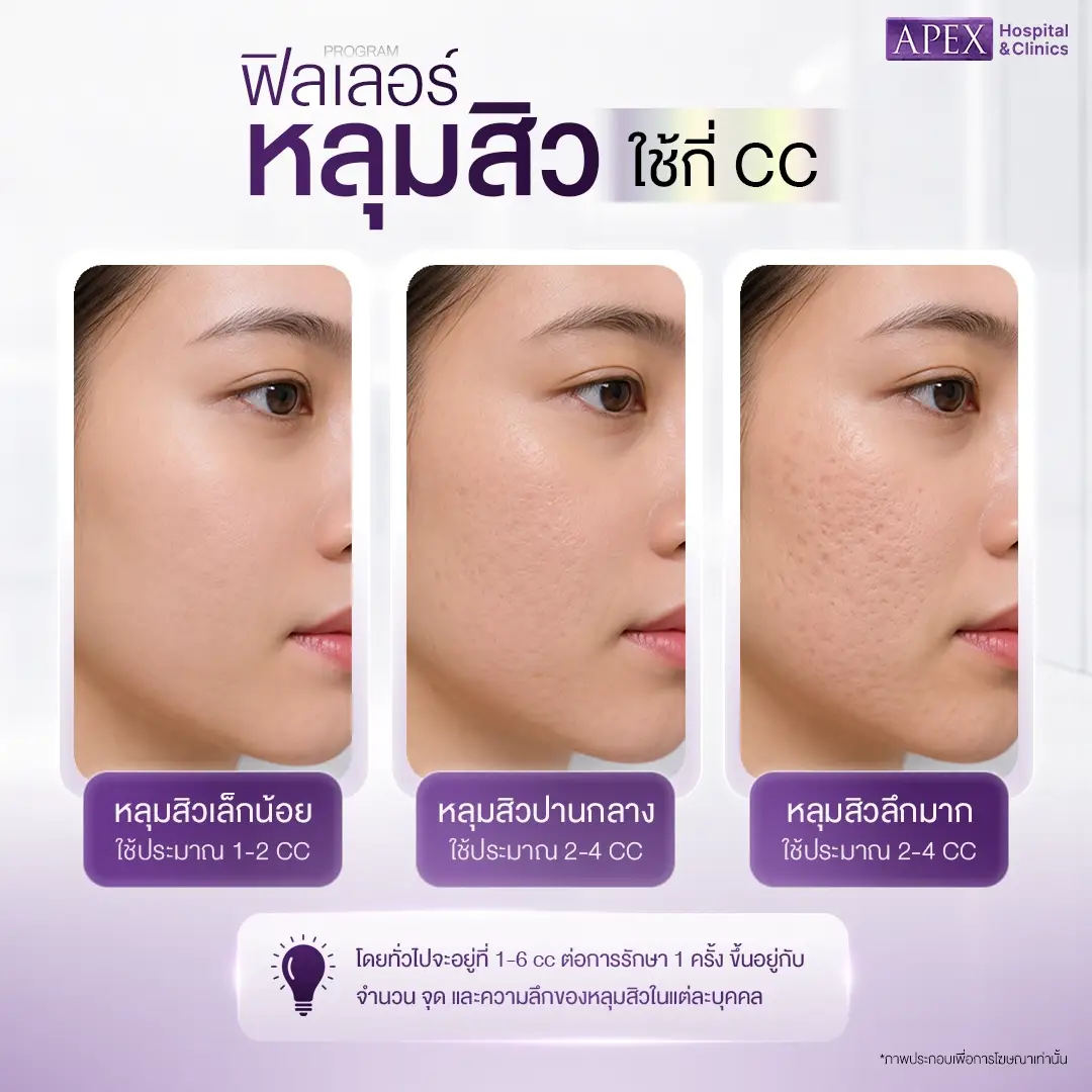 ฟิลเลอร์หลุมสิว ใช้กี่ CC