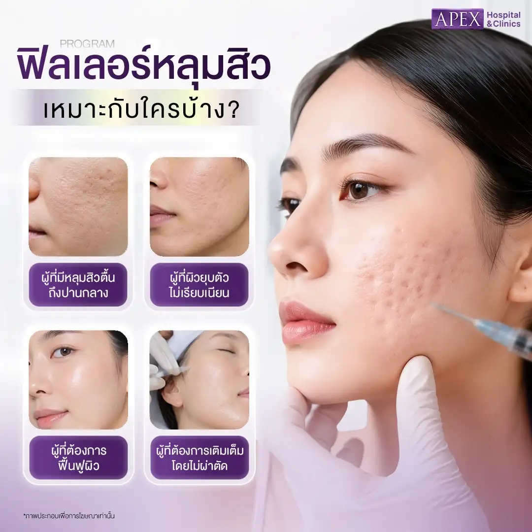ฟิลเลอร์หลุมสิว เหมาะกับใคร