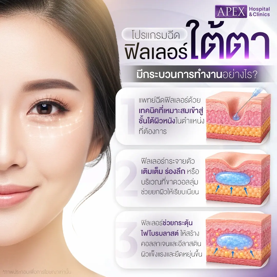 ฟิลเลอร์ใต้ตา ทำงานอย่างไร