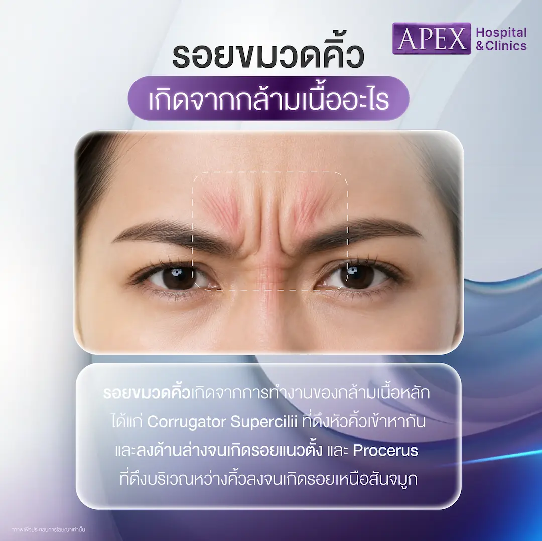 รอยขมวดคิ้ว เกิดจากกล้ามเนื้ออะไร