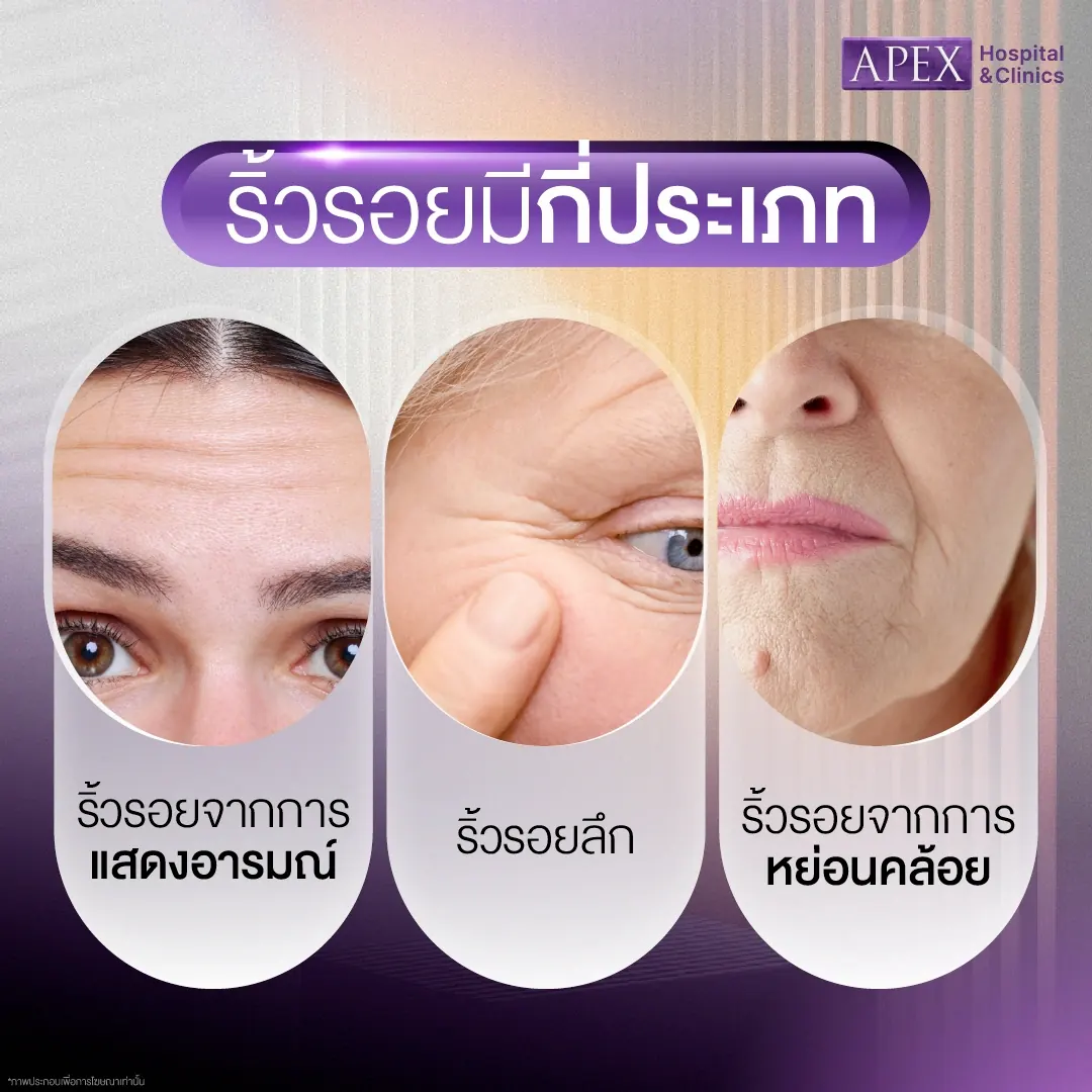 ริ้วรอยมีกี่ประเภท