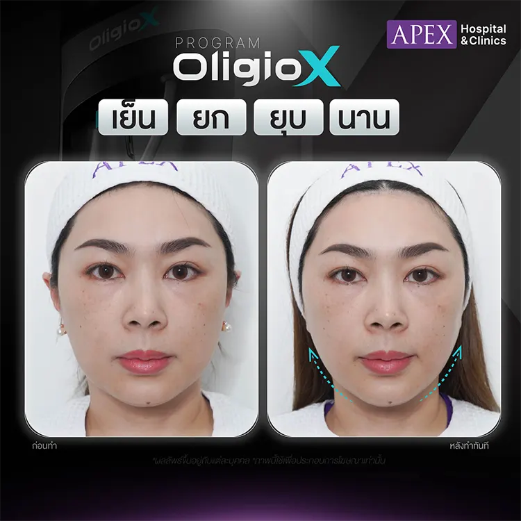 รีวิว Oligio X