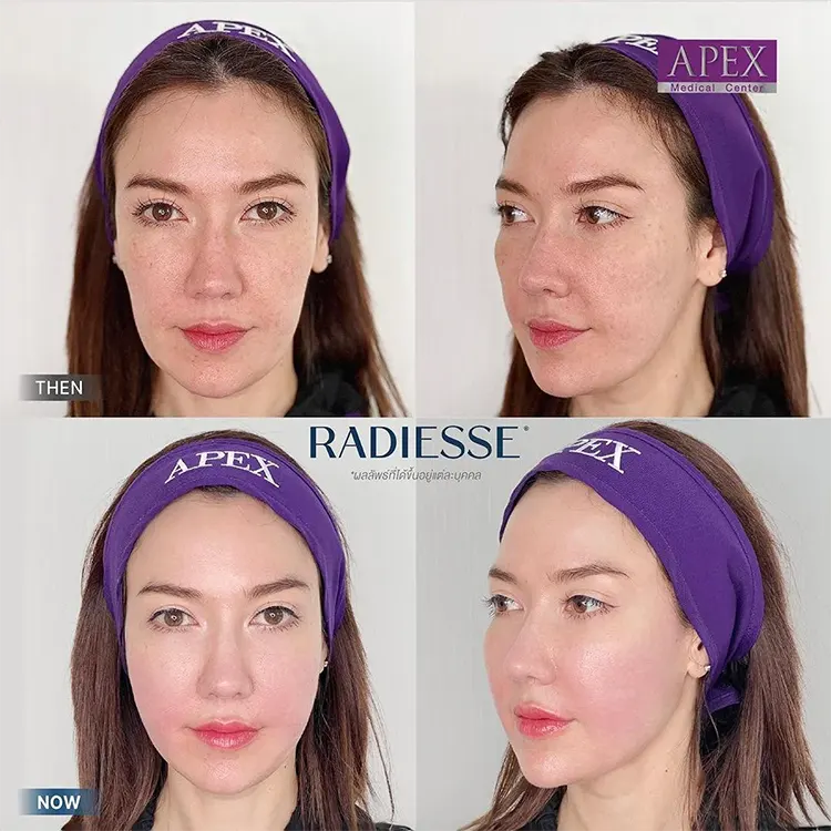 รีวิว Radiesse