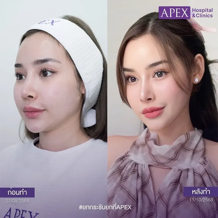 รีวิว Ulthera