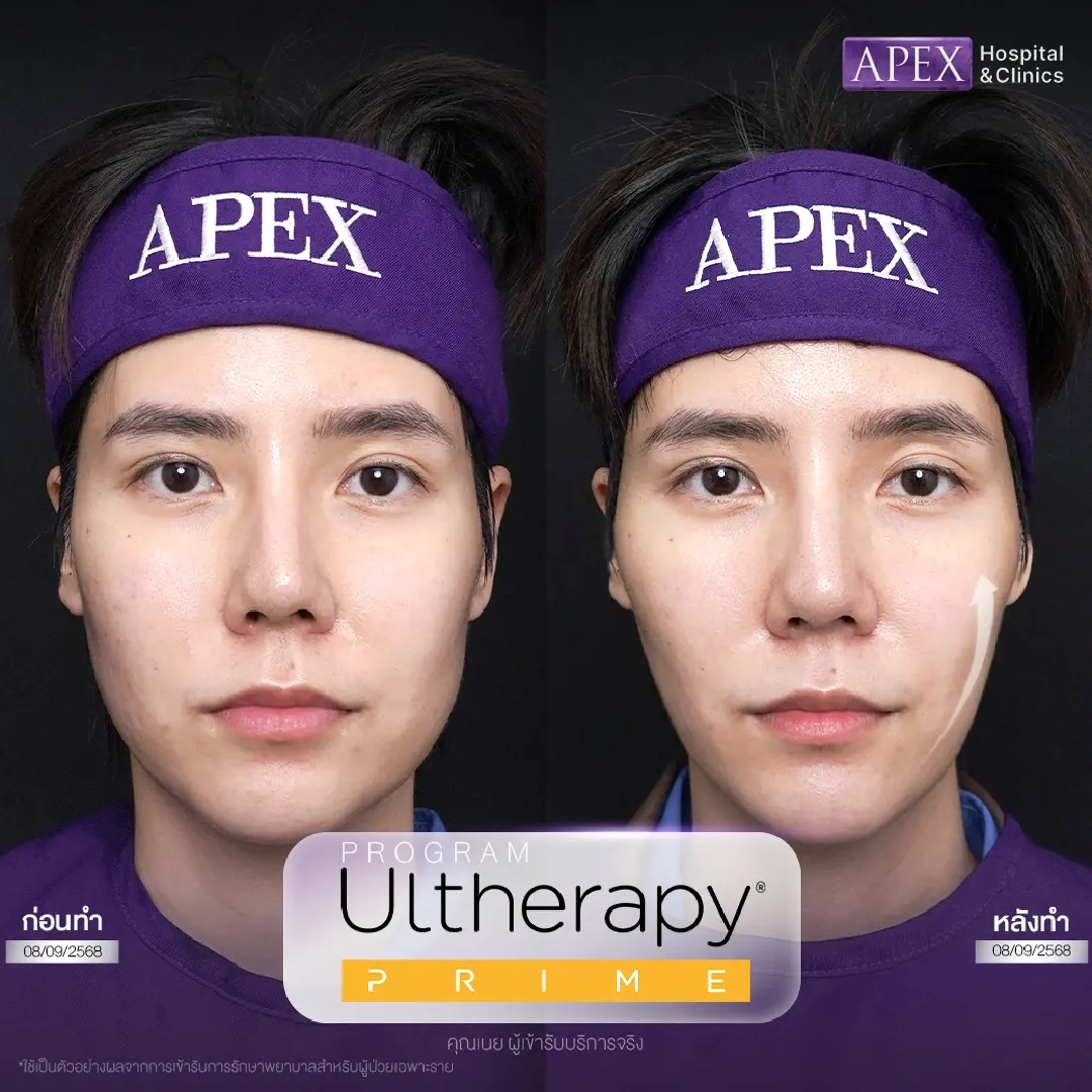 รีวิว Ulthera Prime