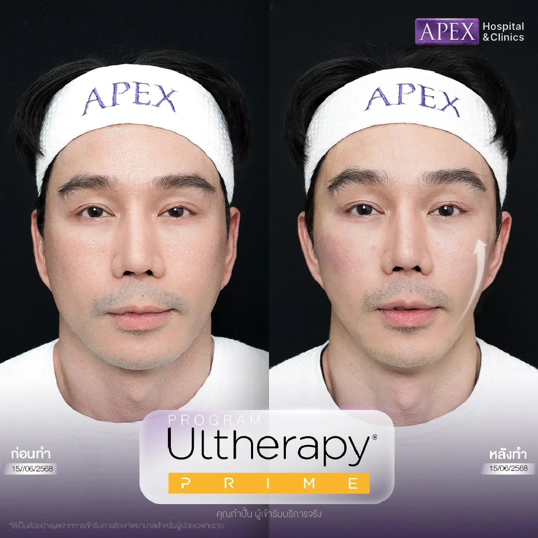 รีวิว Ulthera Prime