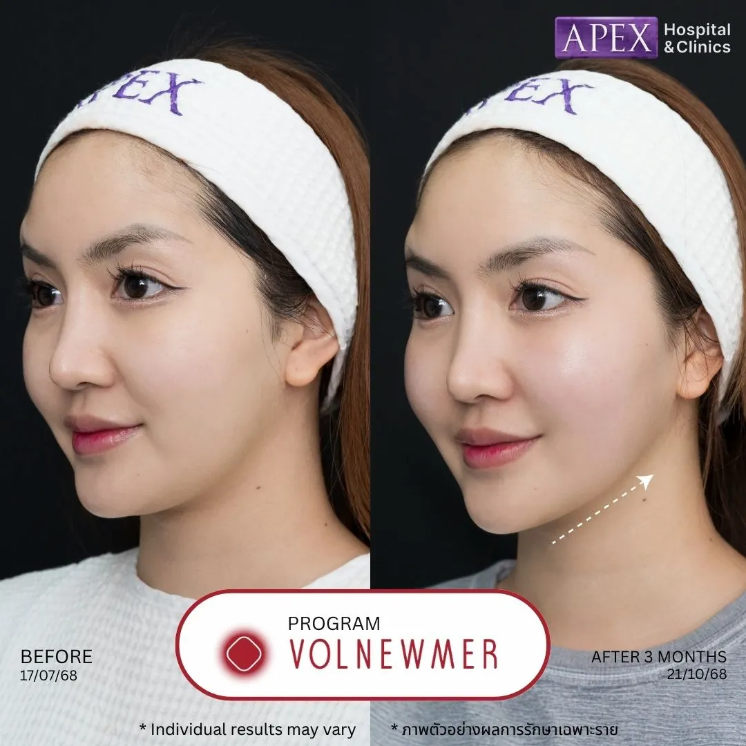 รีวิว Volnewmer ก่อนและหลังทำ 3 เดือน เคสแก้มล่างหย่อนและกรอบหน้าไม่ชัด