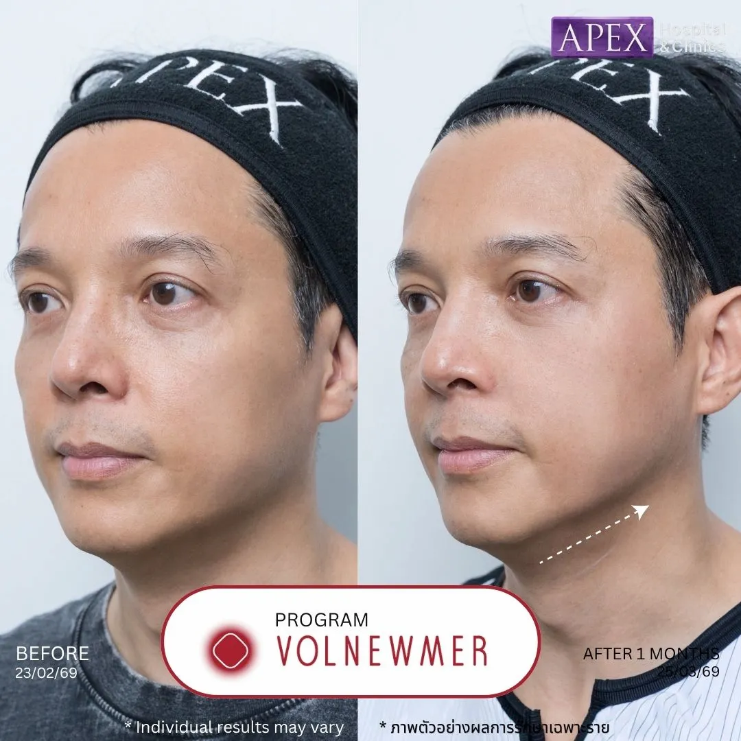 รีวิว Volnewmer ก่อนและหลังทำ 1 เดือน เคสผิวแก้มล่างและใต้คางหย่อน