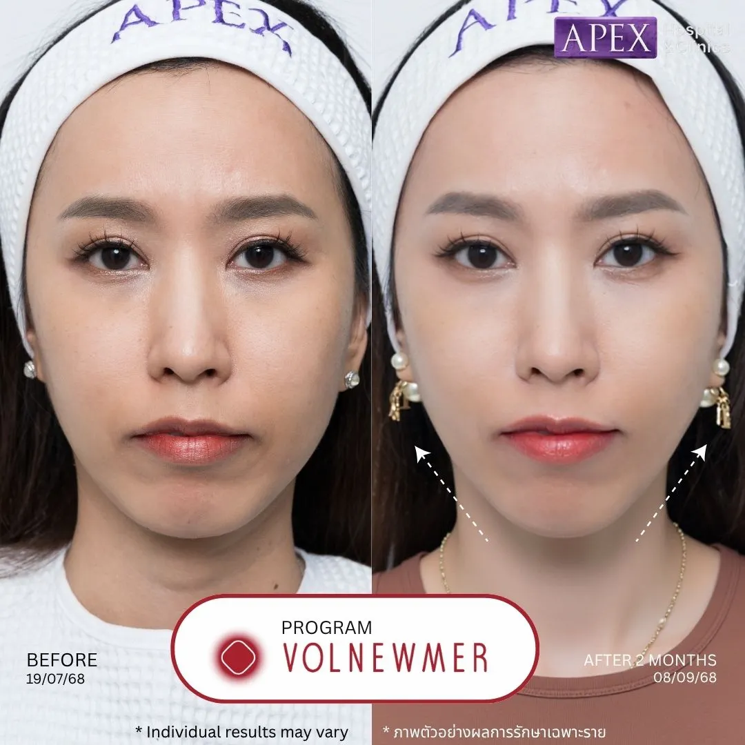 รีวิว Volnewmer ก่อนและหลังทำ 2 เดือน เคสแก้มล่างและรอบมุมปากหย่อน