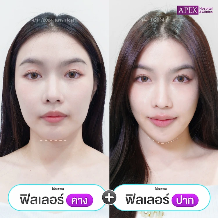 รีวิว ฉีดฟิลเลอร์คาง ปาก