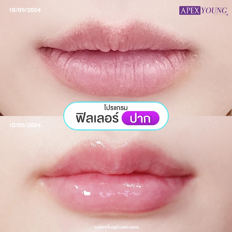 รีวิว ฉีดฟิลเลอร์ปาก