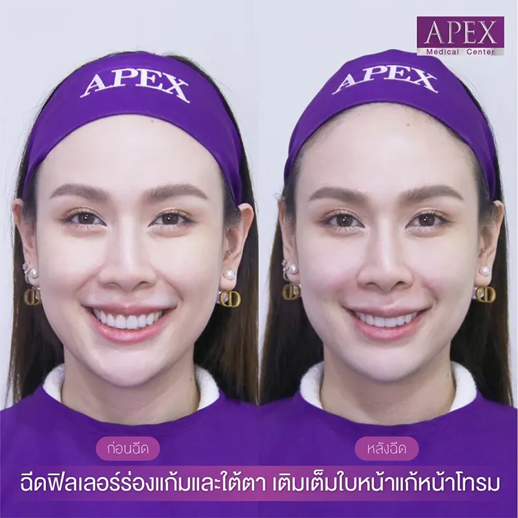 รีวิว ฉีดฟิลเลอร์ร่องแก้ม แก้หน้าโทรม