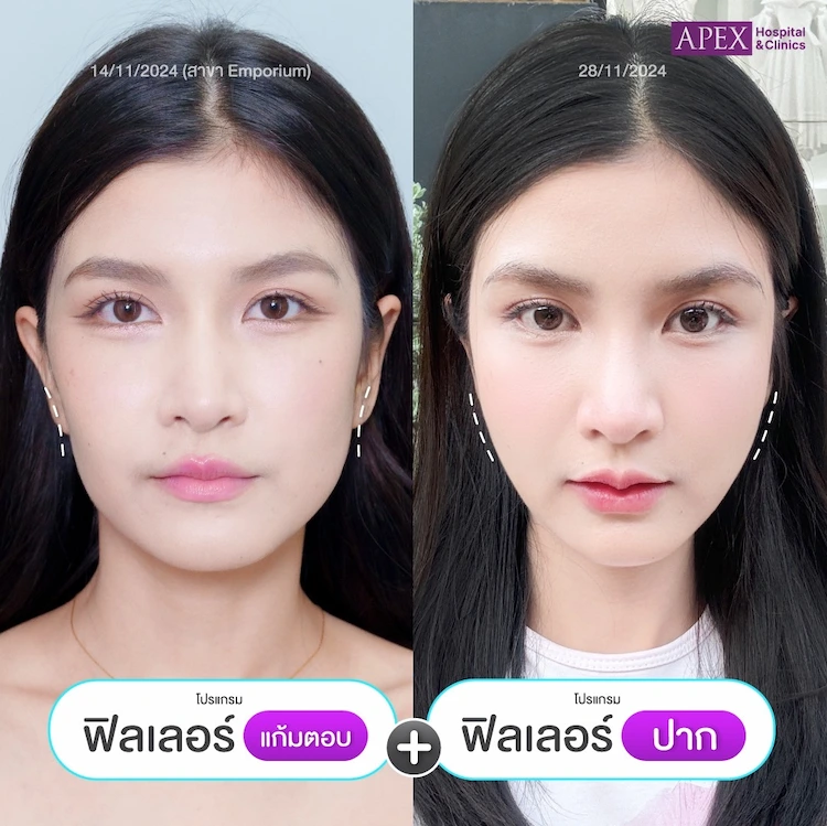 รีวิว ฉีดฟิลเลอร์แก้มตอบ ปาก