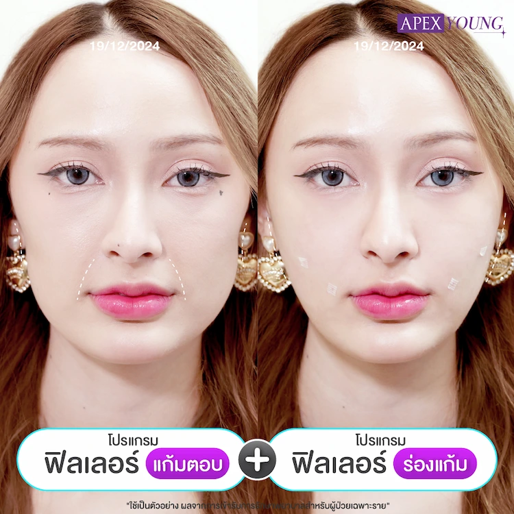 รีวิว ฉีดฟิลเลอร์แก้มตอบ ร้องแก้ม