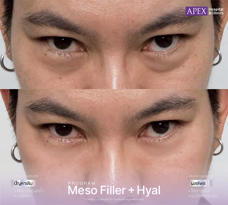 รีวิว ฉีดเมโสหน้าใส