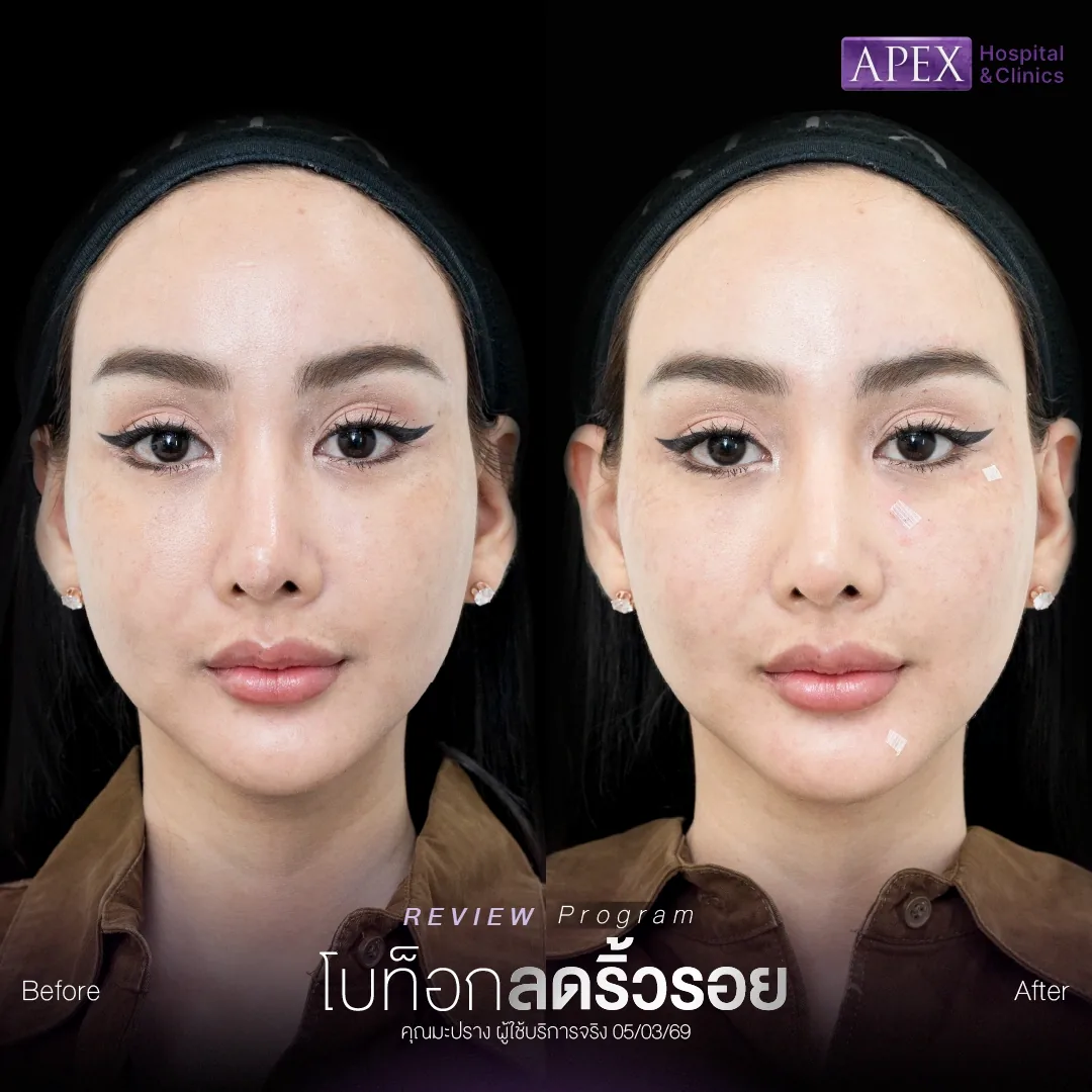 รีวิวฉีดโบท็อกรอยตีนกาบริเวณหางตา