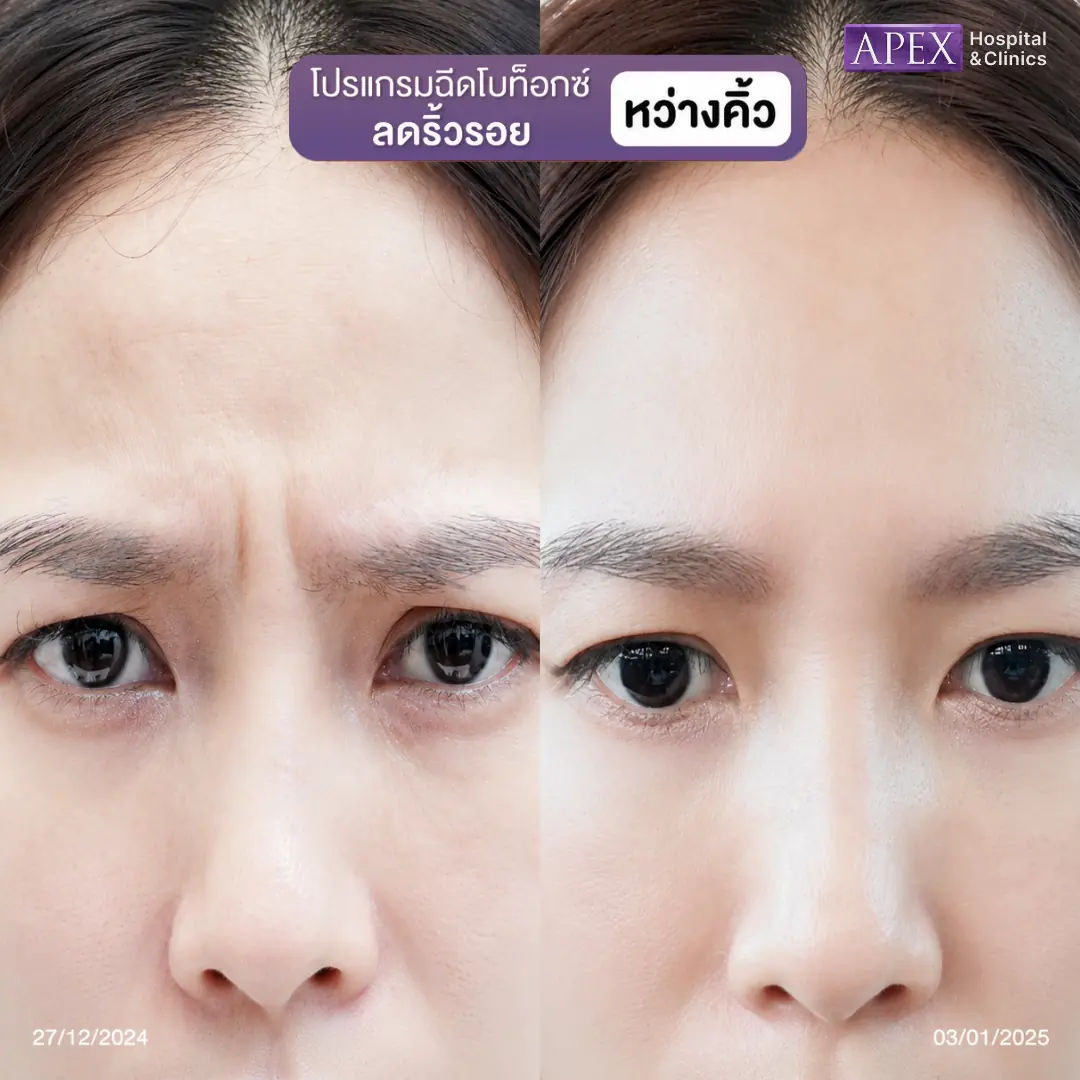 รีวิวฉีดโบท็อกระหว่างคิ้ว