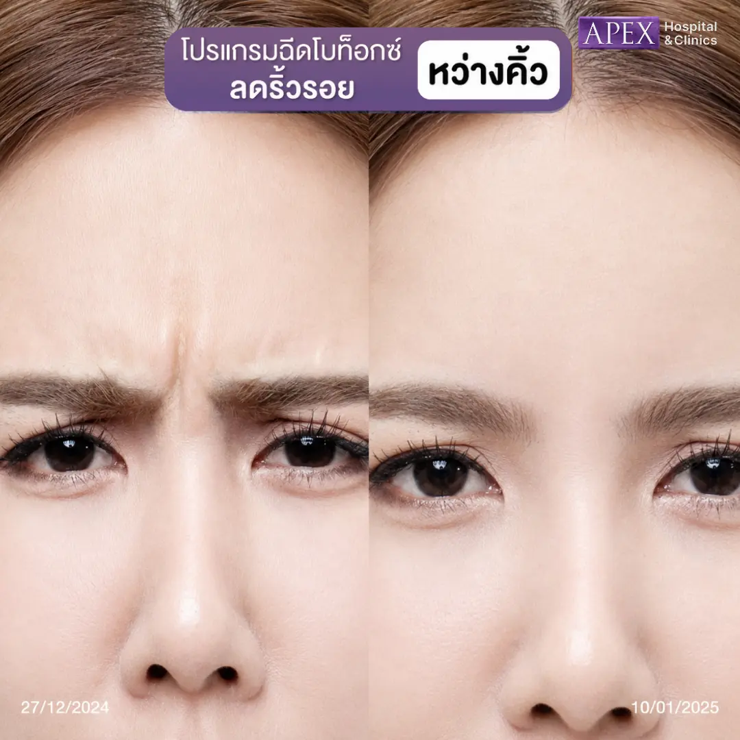 รีวิวฉีดโบท็อกระหว่างคิ้ว