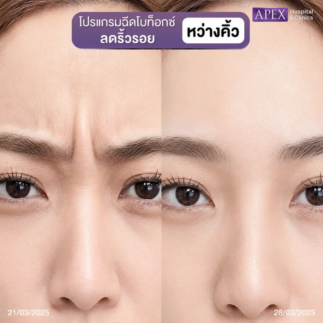 รีวิวฉีดโบท็อกระหว่างคิ้ว