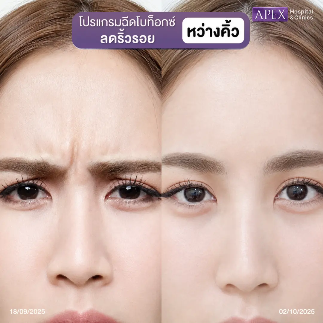 รีวิวฉีดโบท็อกระหว่างคิ้ว