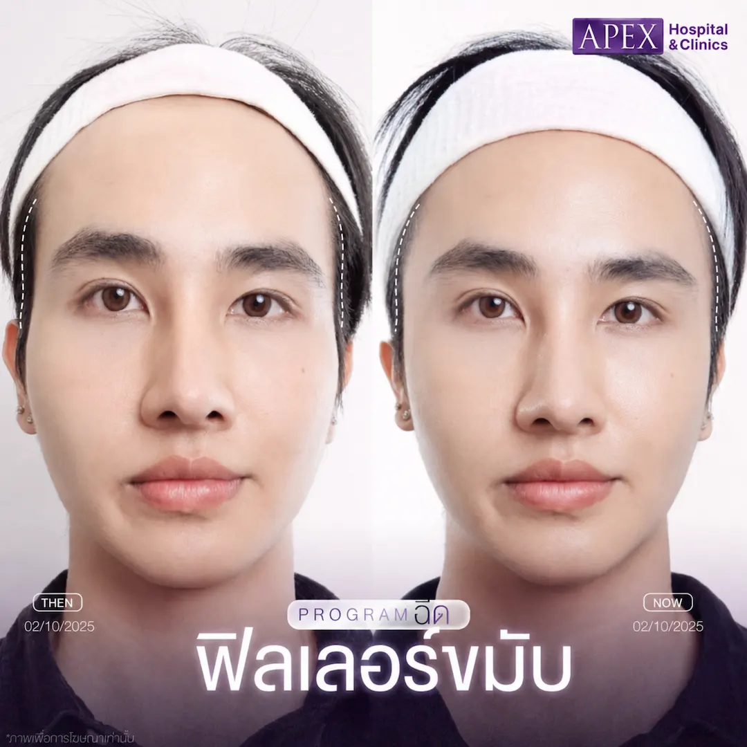 รีวิวฟิลเลอร์ขมับ