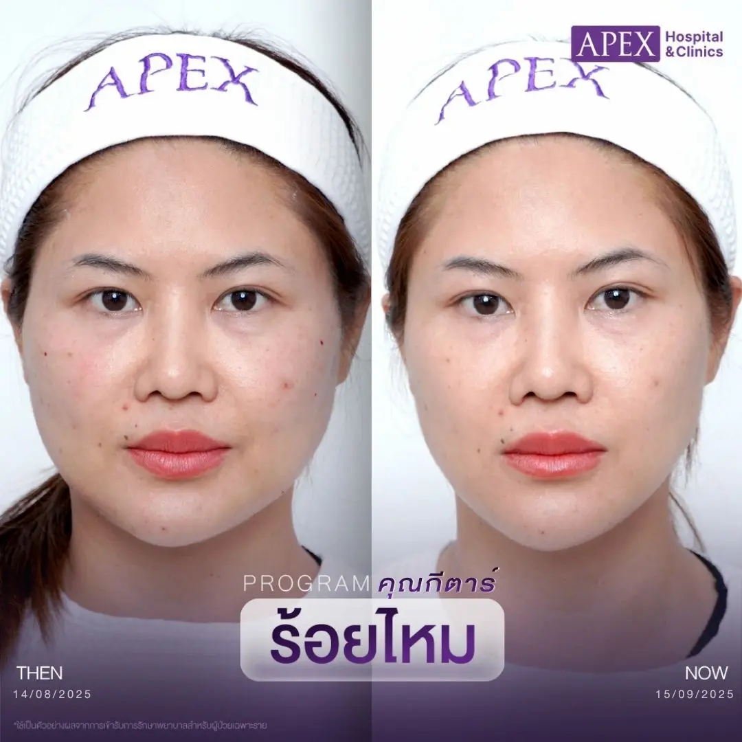 รีวิวร้อยไหม