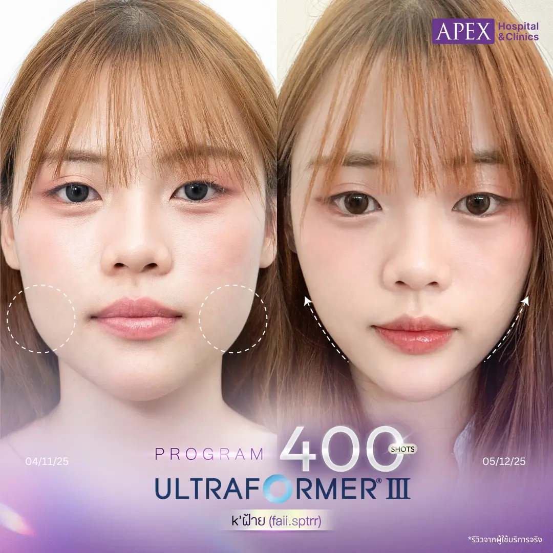 รีวิวหลังทำ Ultraformer III 400 Shots