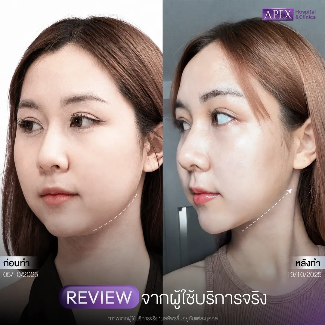 รีวิวโบท็อกกราม เคสที่ 4