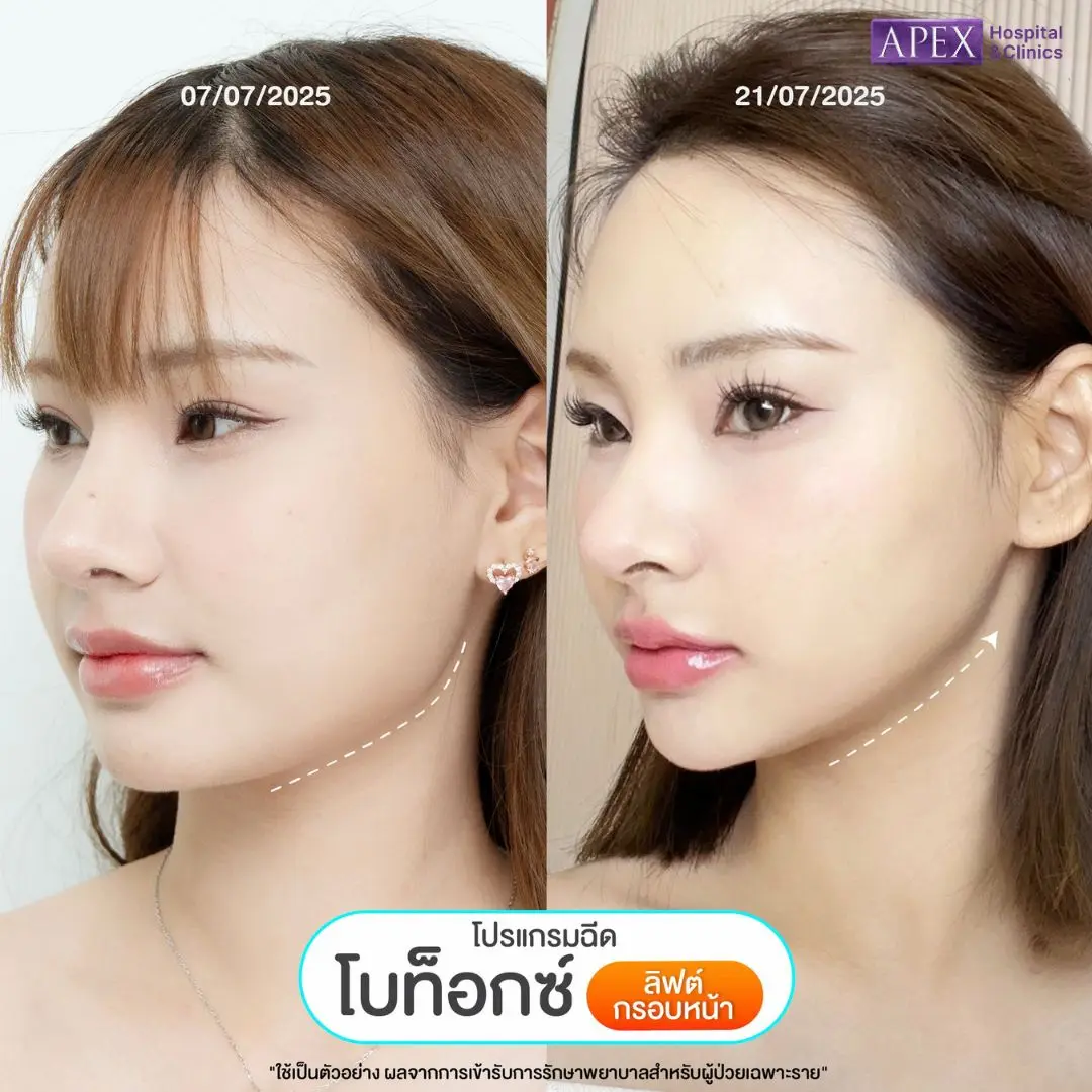 รีวิวโบท็อกลิฟกรอบหน้า