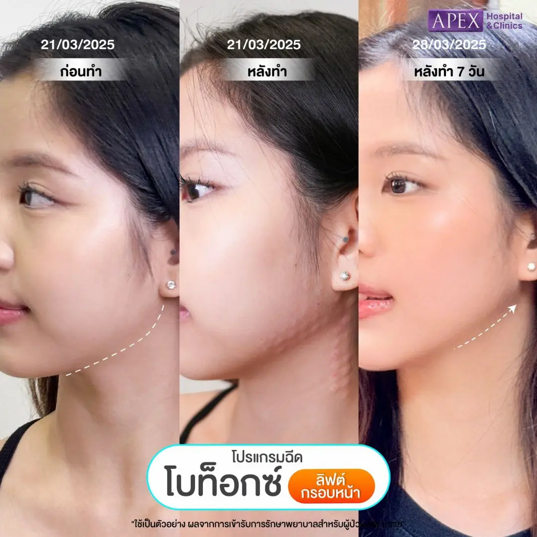 รีวิวโบท็อกลิฟกรอบหน้า