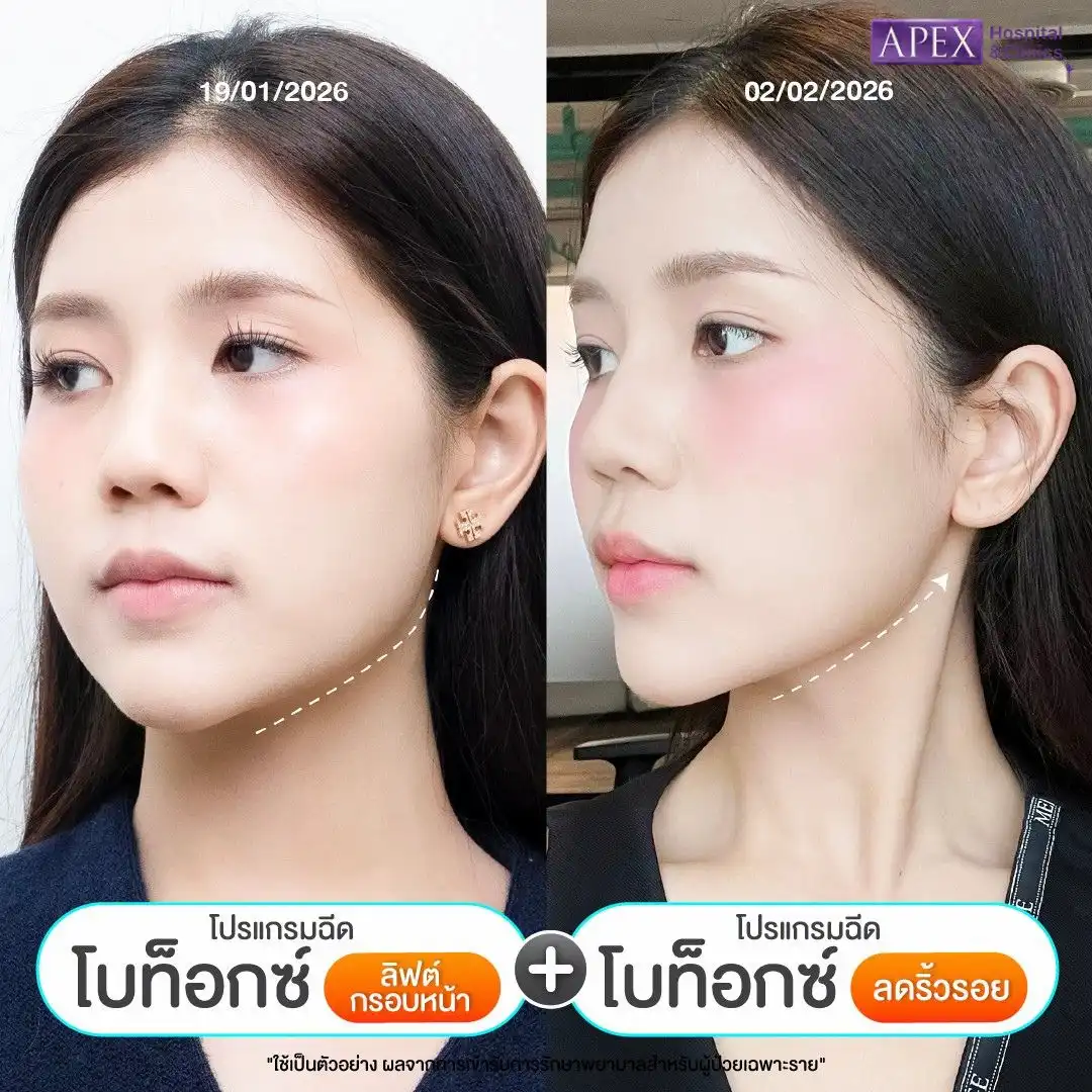 รีวิวโบท็อกลิฟกรอบหน้า