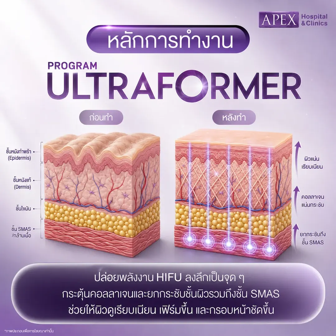 หลักการทำงาน Ultraformer