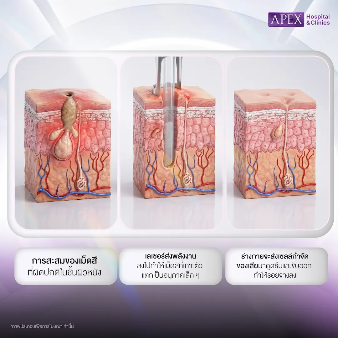 หลักการทำงานของ Pico Toning