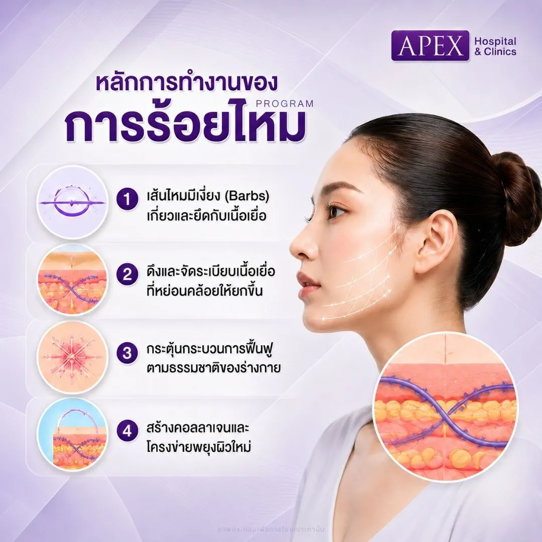 หลักการทำงานของการร้อยไหม