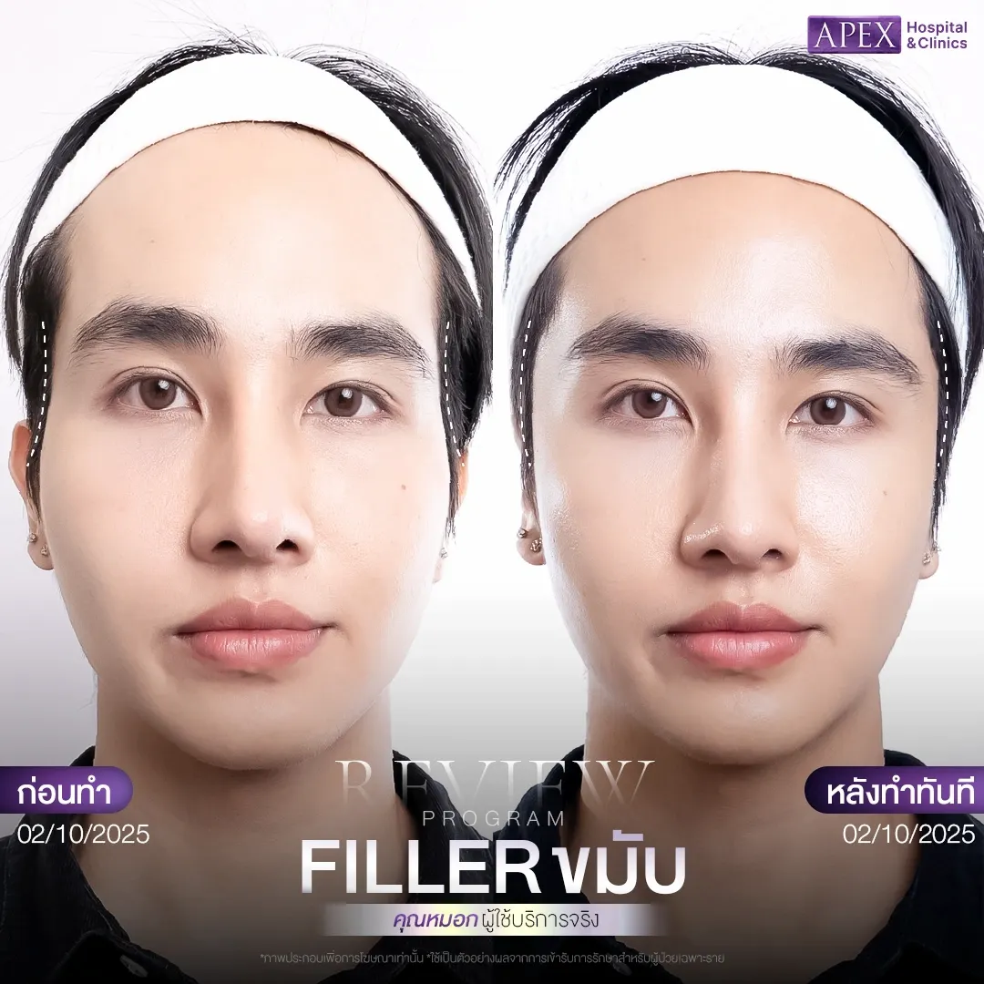 ผลลัพธ์หลังฉีดฟิลเลอร์