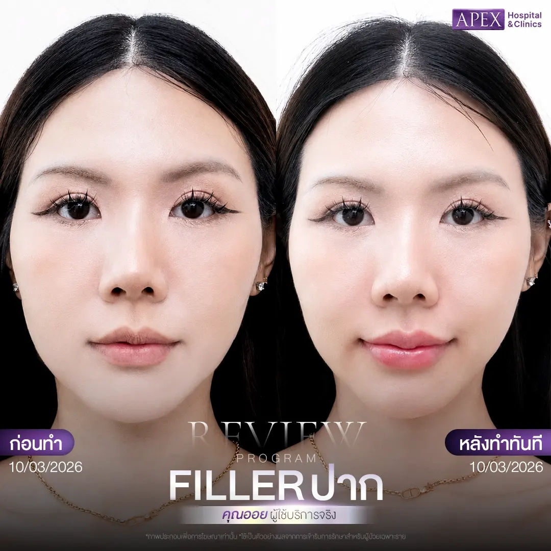 ผลลัพธ์หลังฉีดฟิลเลอร์