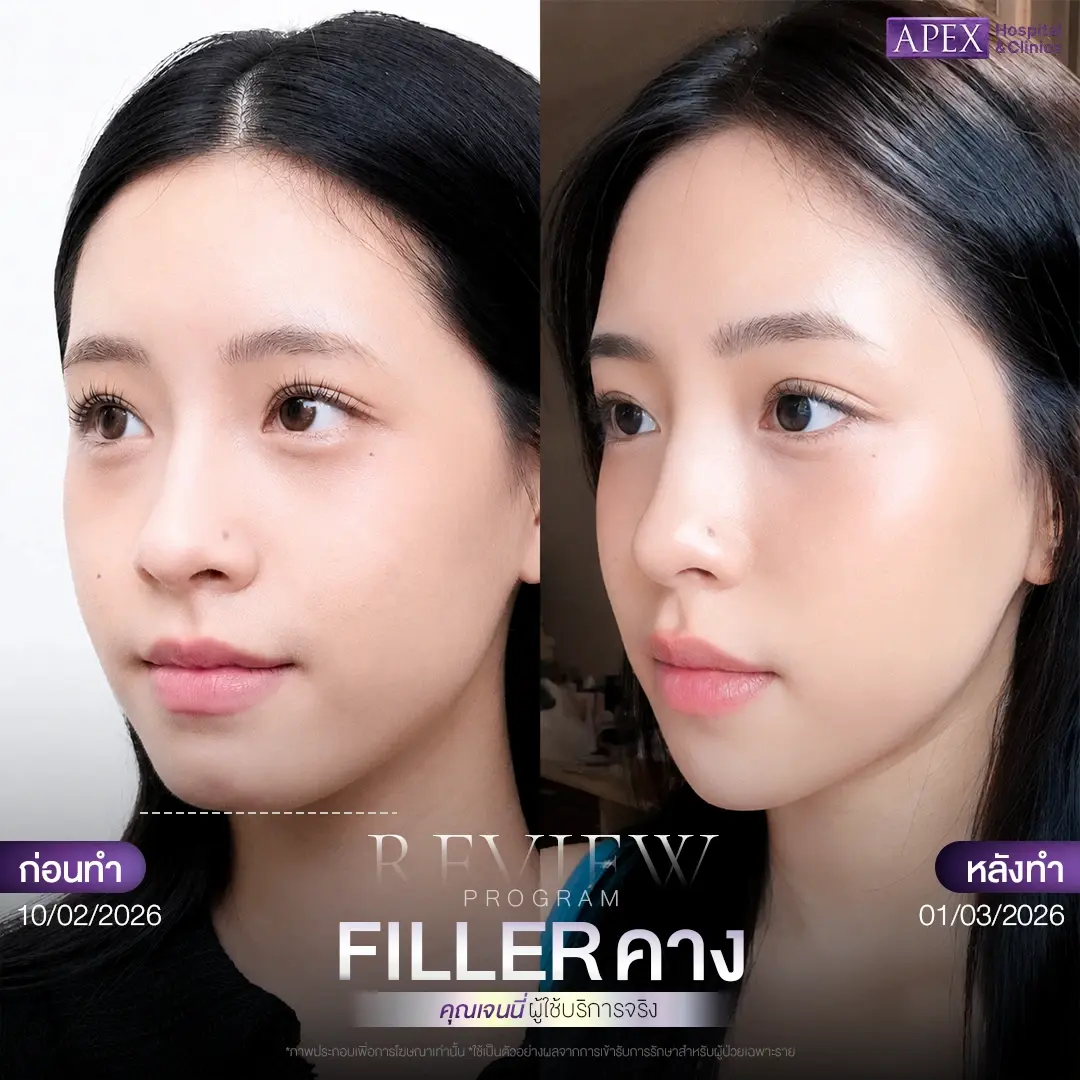 ผลลัพธ์หลังฉีดฟิลเลอร์