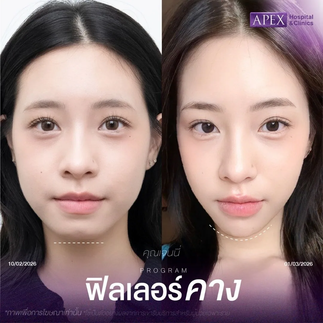 รีวิวฉีดฟิลเลอร์คาง